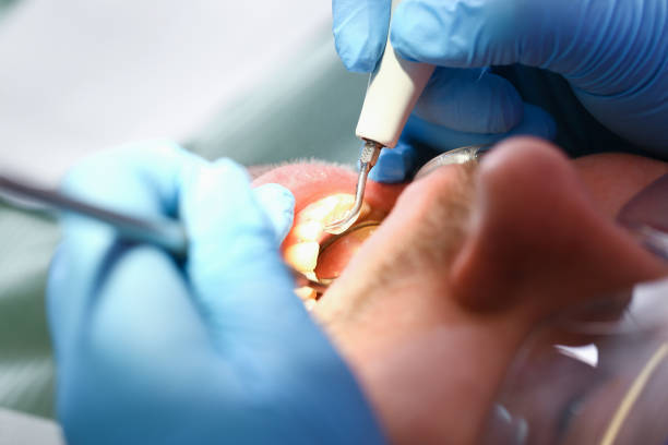 Best Emergency Root Canal Therapy in Torrance, CA